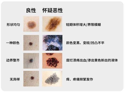 痣中痣|哪些痣会癌变？脸上的痣能点吗？专家这回终于说清楚了